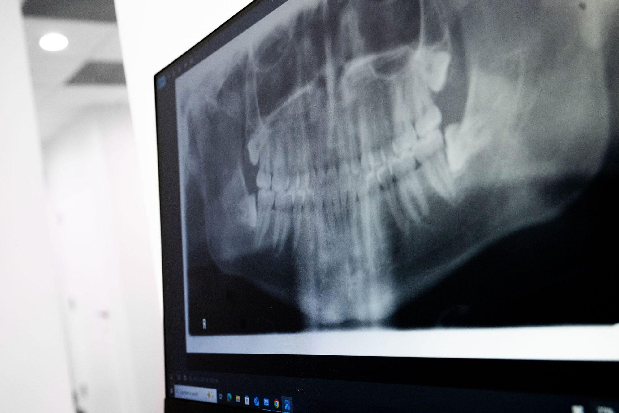 X-ray used to assess bone loss from gum disease